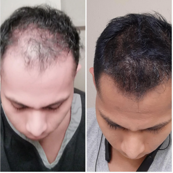 Nanoxidil Con CBD