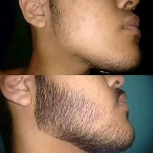 5 Tonico Kayser con Minoxidil al 10%
